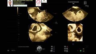 OHSS Ovarian Hyperstimulation Syndrome [upl. by Yecnuahc]