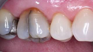 V1904 Reliable Simple Treatment of Cracked Teeth [upl. by Suryt]