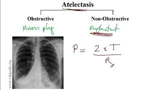 Video 244 Pleural and Pulmonary Conditions Effusion Atelectasis Pneumothorax and Consolidation [upl. by Arval]