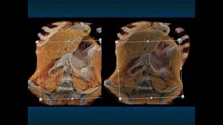 CT of the Aorta amp Its Branches Acute Processes  Part 1 [upl. by Iorgos450]