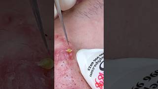 P001  SacDepSpa acne pimple sacdepspa blackheads [upl. by Tedmund]