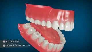 Dental Air Abrasion  Dental Animation [upl. by Otaner]