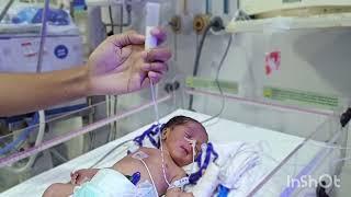 Gavage feeding in babies Nasogastric tube feeding in babies [upl. by Seagraves]