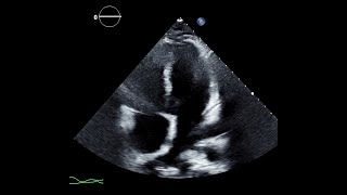 Transthoracic Echocardiogram Showing Signs of Constrictive Physiology [upl. by Helsell]