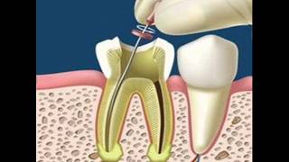 Absceso alveolar crónico Diagnóstico y tratamiento [upl. by Relyuhcs982]