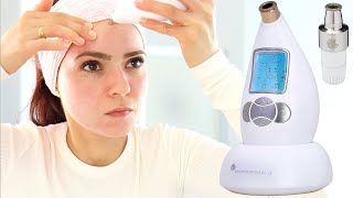 Microderm Glo Review amp How To Use  Microdermabrasion DIY Facial Treatment For Clear Skin [upl. by Phillis118]