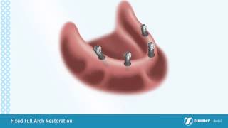 Introduction to Hybrid Implant Dentures [upl. by Adelaide]