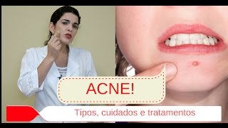 Acne espinhas  Causas Tipos Graus e passo a passo diário para tratar Patrícia Elias  Estética [upl. by Viens]