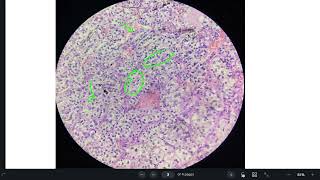 clear cell renal cell carcinoma [upl. by Sadoc]