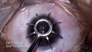 Intra Scleral Haptic Fixation ISHF technique of IOL fixation  Dr Fogla [upl. by Donough137]