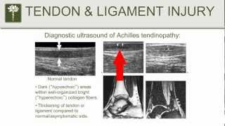 Prolotherapy  Part 3  Joint Pain Tendonitis amp Ligament Pain [upl. by Natalya101]