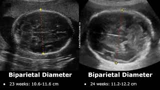 Fetal Biparietal Diameter Ultrasound Normal Values  BPD Measurements  Biometric Parameters USG [upl. by Niac]