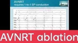 AV Nodal ReEntrant Tachycardia AVNRT  Pathophysiology Typical Versus Atypical ECG Diagnosis [upl. by Felicdad]