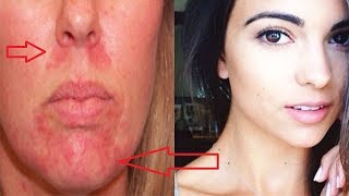 Home Remedies for Perioral Dermatitis Get Rid Red Bumps Around the Mouth [upl. by Greenman]