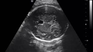 CASE 509 Fetal cavum septum pellucidum CSP [upl. by Pickard]