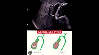 Understanding Cholecystitis and how to care for it Nursing Care Plan [upl. by Pastelki]