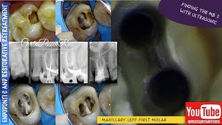 finding MB2 canal ultrasonic tip one curve micromega one visit endodontic treatment [upl. by Atinuj]