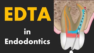 EDTA in Root Canal Treatment [upl. by Germano]