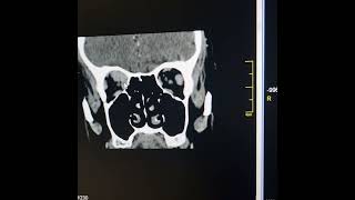 Tumefactive inflammatory pseudotumor of orbit IgG4 related orbital disease [upl. by Adnerb]