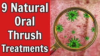 9 Natural Oral Thrush Treatments [upl. by Tammie786]