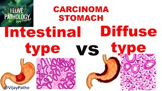 Carcinoma Stomach INTESTINAL VS DIFFUSE GASTRIC CANCER [upl. by Notreb468]