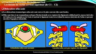 Pr Atia Traumatisme du rachis cervical 2 [upl. by Cho677]