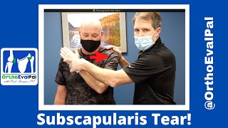 Subscapularis Rotator Cuff Tear [upl. by Riabuz]