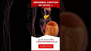 Abnormal position of fetus [upl. by Bev]