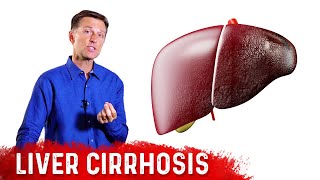 Is Liver Cirrhosis Reversible  Fibrosis vs Cirrhosis – DrBerg [upl. by Deth]