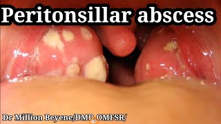 Peritonsillar abscess [upl. by Idnek]