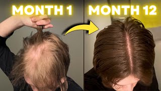 I Stopped Hair Loss in 30 Days with These Treatments [upl. by Wun]