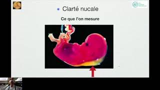 Dépistage De La Trisomie  Formation Echographie Obstétricale Maroc [upl. by Ihsakat]