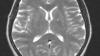 Sinus thrombosis pseudotumor cerebri and seizure disorder [upl. by Selden700]