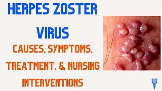 HERPES ZOSTER Symptoms Causes Treatment amp Nursing Interventions [upl. by Yrtua176]