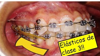 Elásticos intermaxilares de clase 3 en ortodoncia 💪como se usan [upl. by Solracnauj]