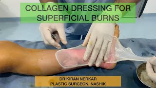 Collagen Dressing in first degree burns  Dr Kiran Nerkar  Plastic Surgeon Nashik [upl. by Cassidy]