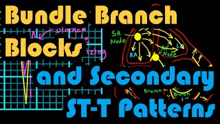 Bundle Branch Blocks and Secondary STT Patterns How to Read an EKG Curriculum [upl. by Ethe]