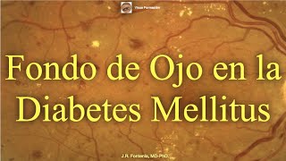 Clase de Fondo de Ojo en la Diabetes Mellitus Retinopatía Diabética [upl. by Dilly]