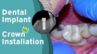 104 Dental Implant Crown Installation [upl. by Aeslek]