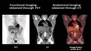 PETCT Positron Emission Tomography  Computed Tomography [upl. by Eidualc832]