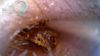 Earwax Removal EP29 [upl. by Kayley]