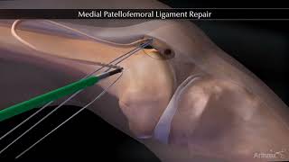 Reparation ligament fémoropatellaire MPFL  Chirurgie Instabilité de rotule  Dr Tournemine [upl. by Kushner]