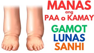 Manas ang Kamay o Paa  Gamot at Lunas  Mga Posibleng SANHI ng PAMAMANAS  Home Remedies  EDEMA [upl. by Butch724]