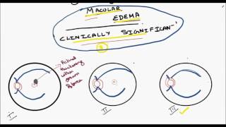 clinically significant macular edema [upl. by Klepac835]