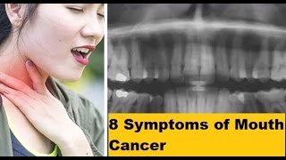 8 Symptoms of Mouth Cancer That You Need To Know Before [upl. by Nannah]