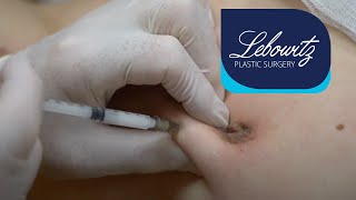 Treatments for Keloid Scars QampA with a dermatologistDr Dray [upl. by Blunk378]