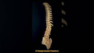 Understanding Ankle Lateral Malleolar Fractures A Comprehensive Guide [upl. by Atiragram]