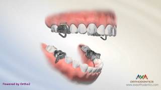 Orthodontic Treatment for Overjet Overbite  MARA Appliance [upl. by Langille688]