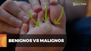 ✅ Diferencias entre TUMORES benignos y malignos  Salud180 🌿 [upl. by Anelac]