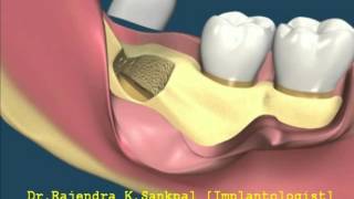 removal of horizontal impacted wisdom teeth [upl. by Anauqahs285]